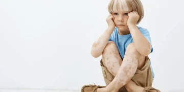 Child-with-Kawasaki-Disease